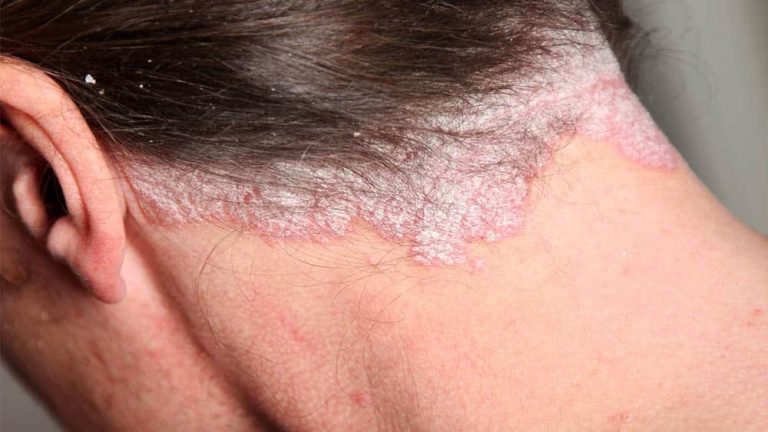 psoriase no couro cabeludo