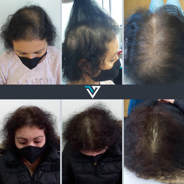 tratamento capilar antes e depois