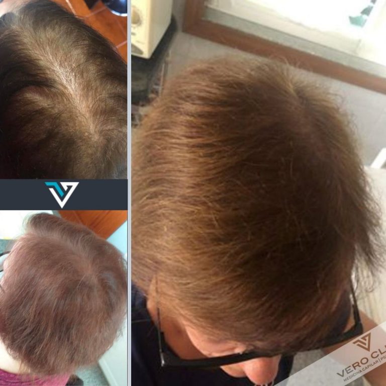 tratamento recuperação capilar