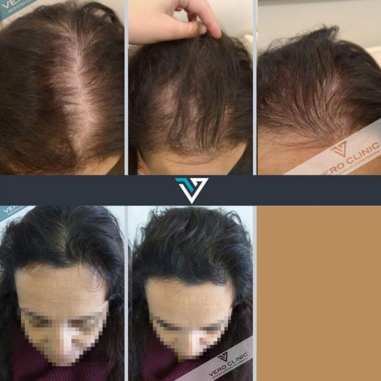 antes e depois tratamento capilar