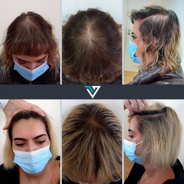 tratamento capilar avançado