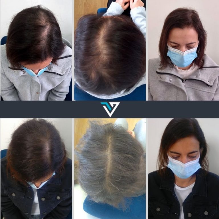 tratamento capilar antes e depois