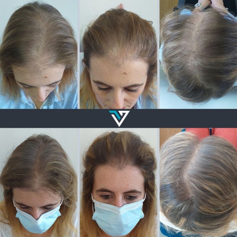 tratamento de recuperação capilar