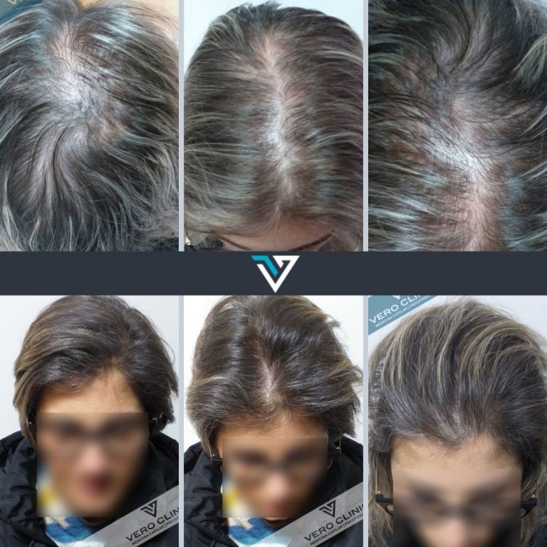 tratamento capilar vero clinic