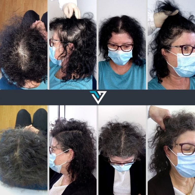 tratamento capilar antes e depois