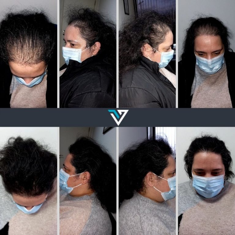 tratamento capilar avançado