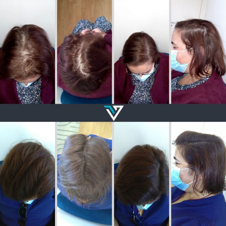 tratamento capilar alopecia