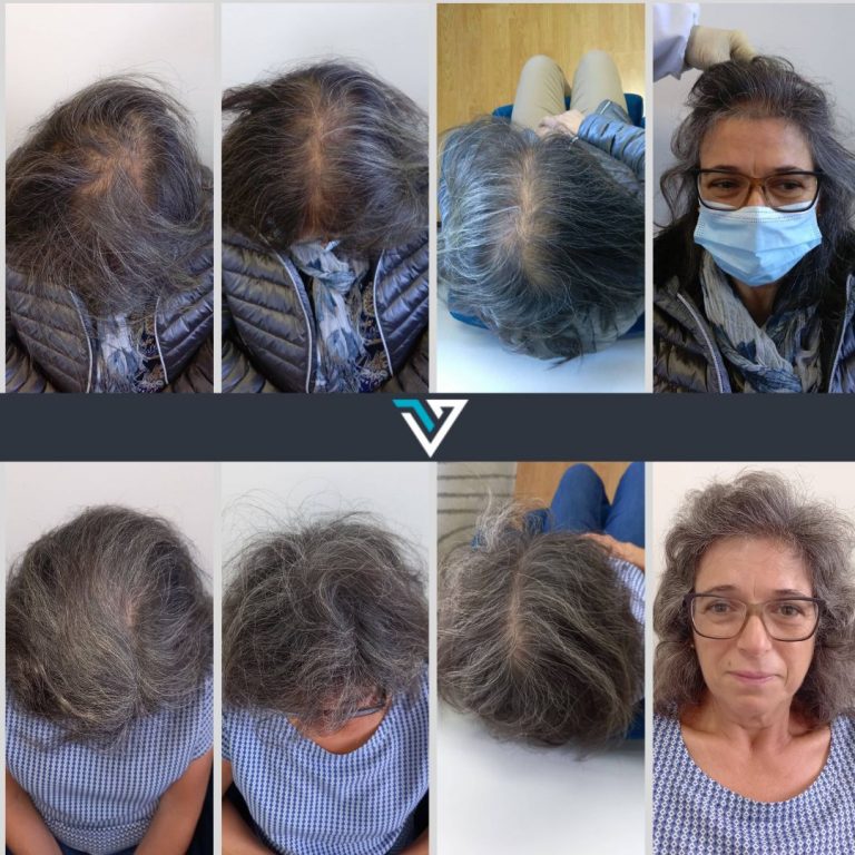 tratamento da alopecia