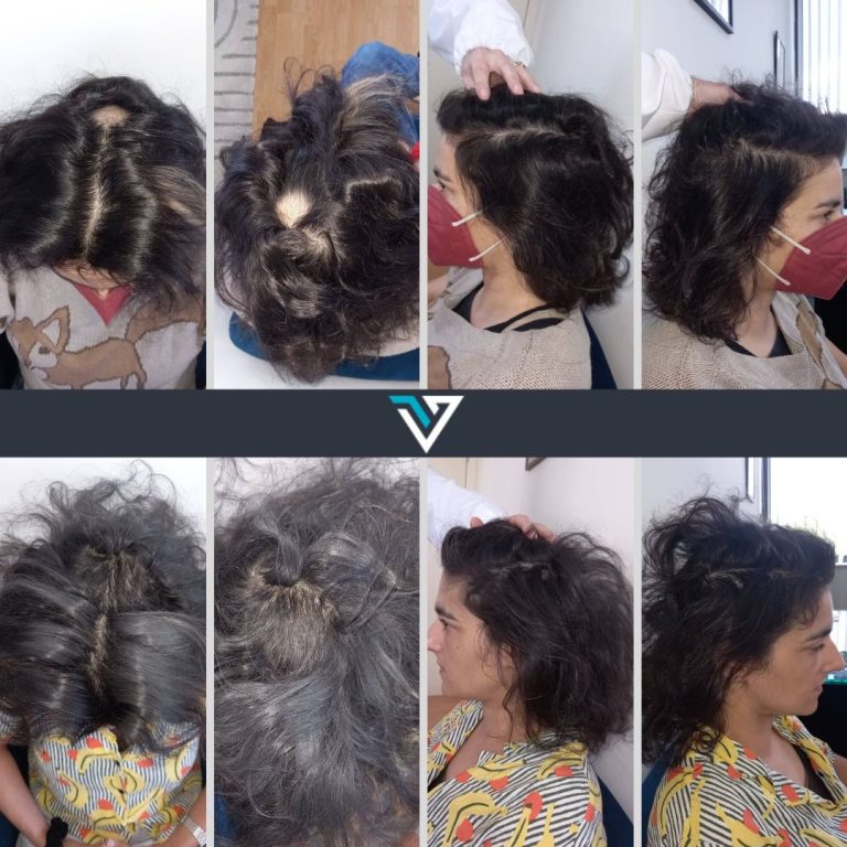 tratamento da alopécia areata