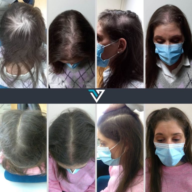 tratamento capilar avançado