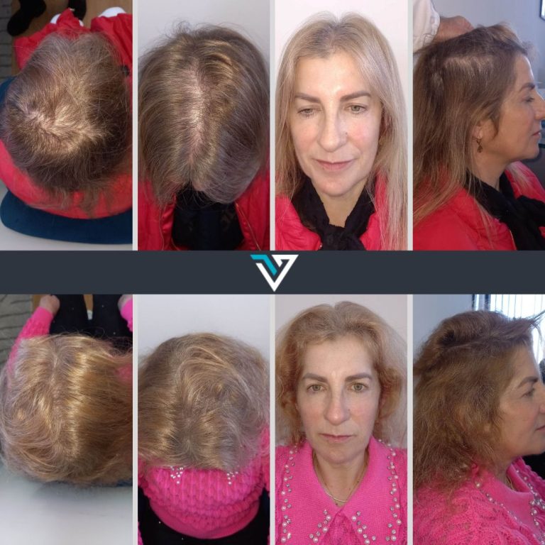 tratamento capilar avançado