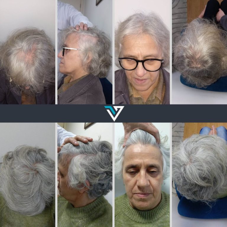 tratamento da alopécia