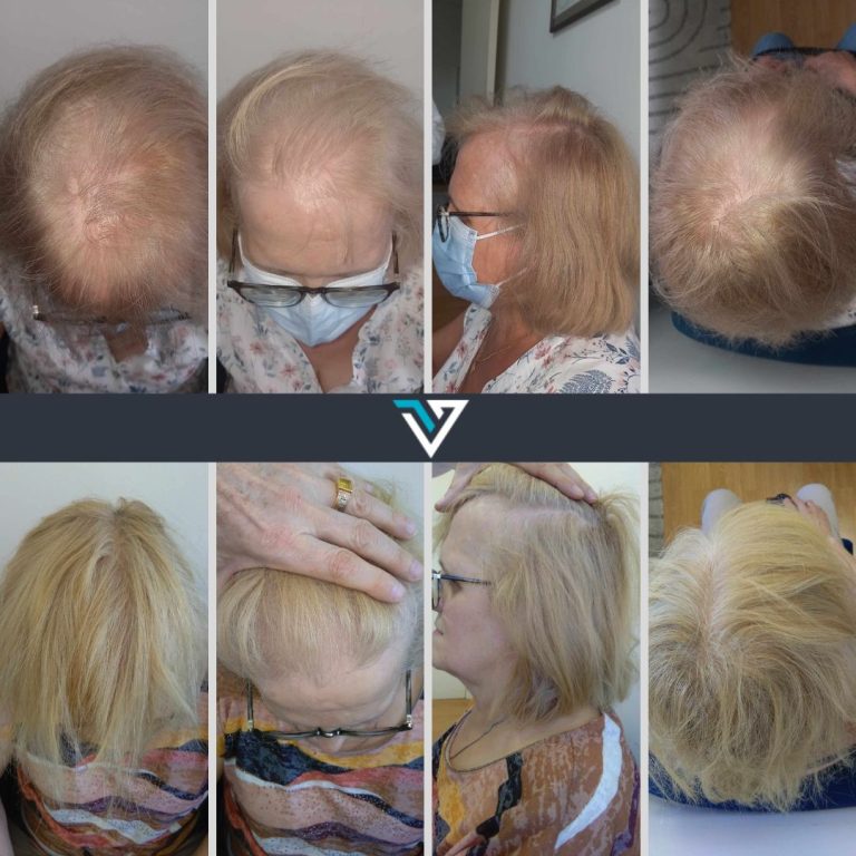 tratamento da alopécia