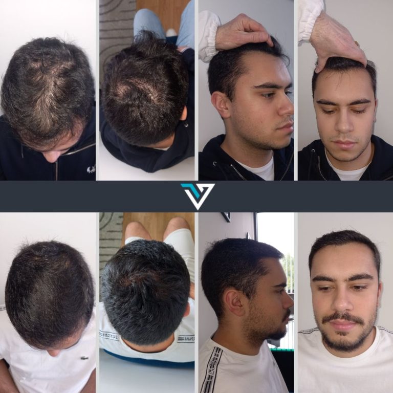 tratamento capilar homem