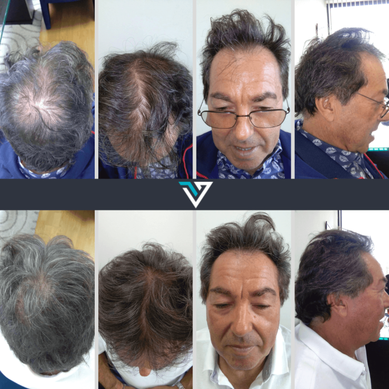 tratamento capilar homem