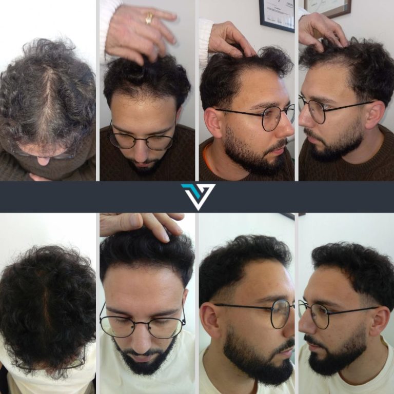 tratamento capilar homem